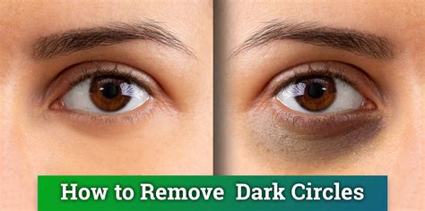 Effective Natural Remedies To Get Rid Of Dark Eye Circle In Indiana ...