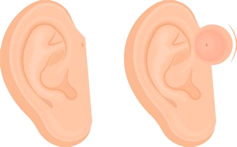 Pre-auricular pits & sinuses - Ear Surgeon