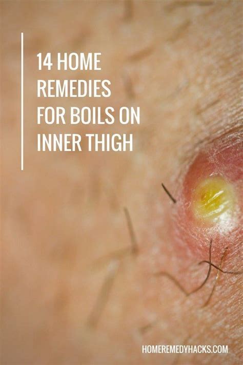 14 Proven Home Remedies for Boils on Inner Thigh | Home remedy for ...