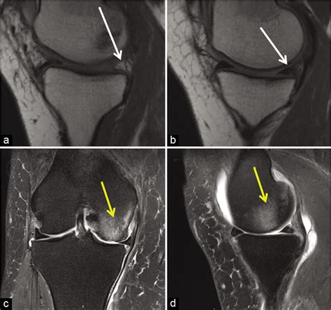 Meniscal root tears: Solving the silent epidemic - Journal of ...