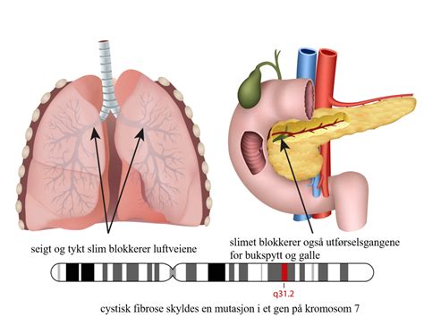 cystisk fibrose – Store medisinske leksikon