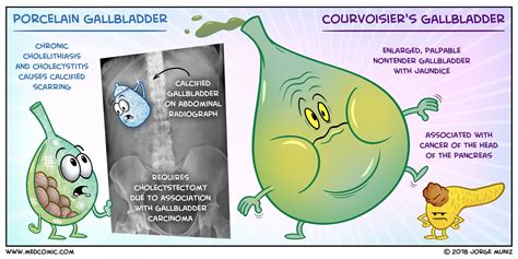 Porcelain Gallbladder vs. Courvoisier’s Gallbladder BY JORGE MUNIZ, PA ...