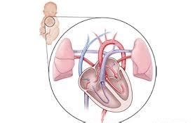 Atrioventricular canal defect