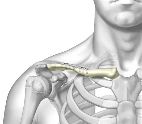 Superior Midshaft Clavicle Plate - Upper Extremity Implant - TriMed Inc.