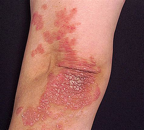 Psoriasis - Appearance, Causes, Types, Symptoms, Treatment, and Diet
