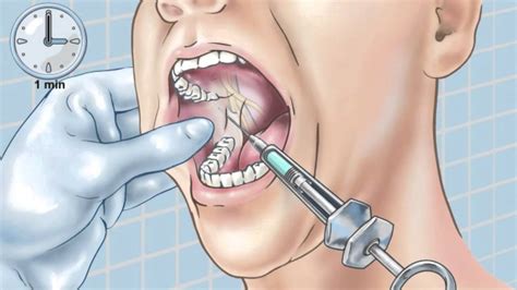 Standard Inferior Alveolar Nerve Block - YouTube