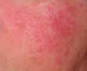 Gluten Rash - Symptoms, Causes, Treatment, Pictures