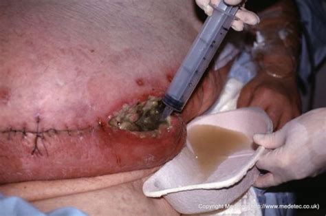 Abdominal Wound Infection