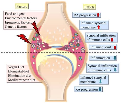 Rheumatoid Arthritis - Causes, Signs, Symptoms, Diet, Treatment