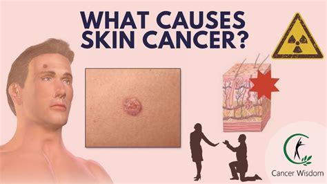 The Skin Cancer Mystery Revealed - Why People Get Skin Cancer Melanoma - YouTube