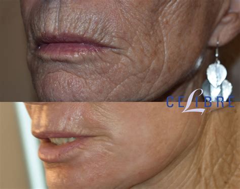 Juvederm For Smokers Lines Before And After - Infoupdate.org