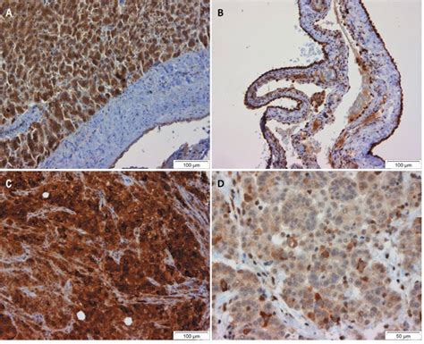 Abdominal Mesothelioma Stage