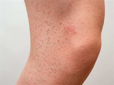 Red Itchy Bumps On Forearm