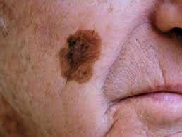 Lentigo Maligna Melanoma (LMM) Skin Cancer Treatment Houston TX, Spring