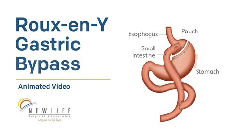 Roux-en-Y Gastric Bypass - YouTube