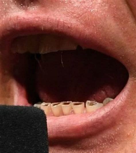 What is wrong with Brock Lesnar's teeth? | Freakin' Awesome Network Forums