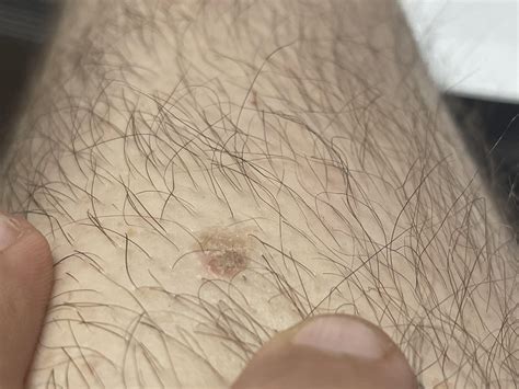 Finally got my crusty mole tested : r/Melanoma