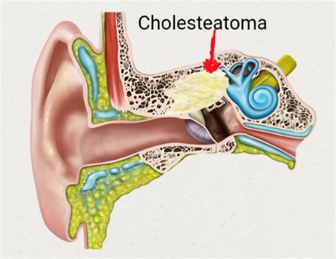 Cholesteatoma Ear Surgery