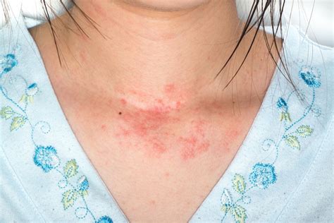 Rash 36 Common Skin Rashes Pictures Causes Treatment - vrogue.co