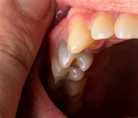 Black Teeth: Symptoms, Causes and Treatment - The Dental Centre