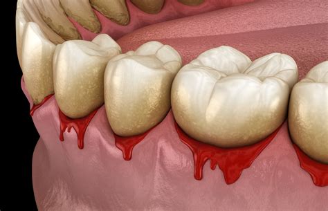 How to Treat Gum Disease - Dentists in Strongsville, OH