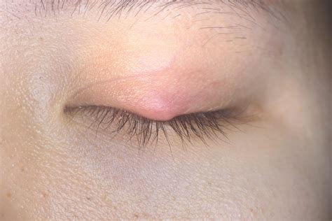 Orbital Cellulitis: This Eye Infection is Not Like Others - Fante Eye ...