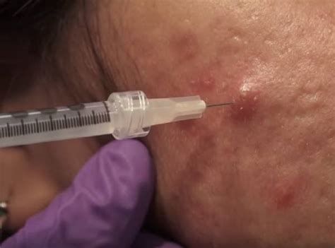 Acne Cortisone + Antibiotic Injection | Edwin Lim Medical Aesthetic Clinic