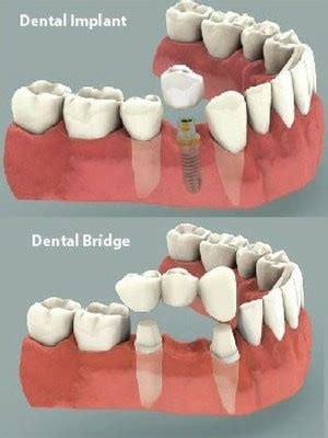 What is Porcelain Dental Bridge?