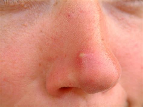 Acne Cyst On Nose