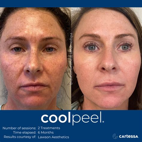 CoolPeel CO2 Laser Resurfacing Treatment in Jacksonville, Florida | Hello Smooth Med Spa