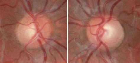 Evaluating the cup and disc in glaucoma - EyeGuru