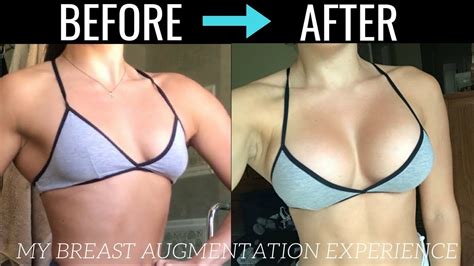 Breast Augmentation Before And After A To C