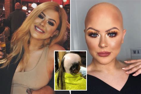 Make-up artist who was diagnosed with alopecia at 16 and tried to cover her bald spots with dry ...