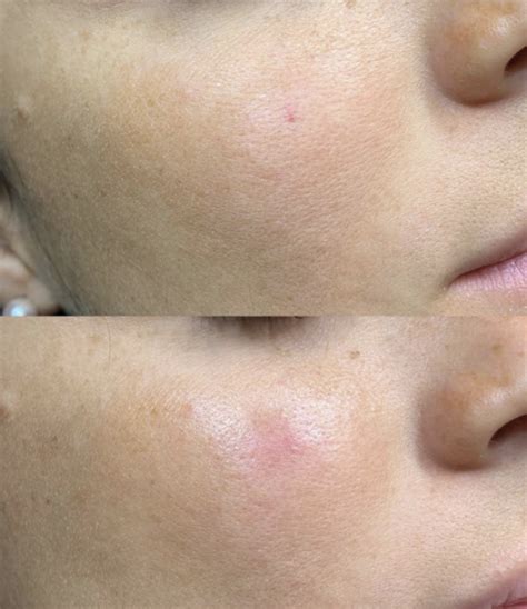 Cherry Angioma Removal | It's A Secret Med Spa