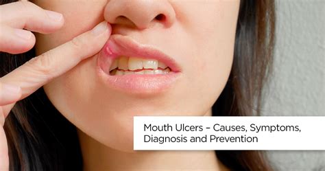 Mouth Ulcer | Mouth Ulcer Treatment, Causes and Symptoms