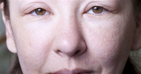 Angioedema: Treatments, types, and symptoms