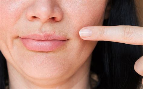 How To Get Rid Of Pimples On Your Lips With Ayurvedic Remedies? – Vedix