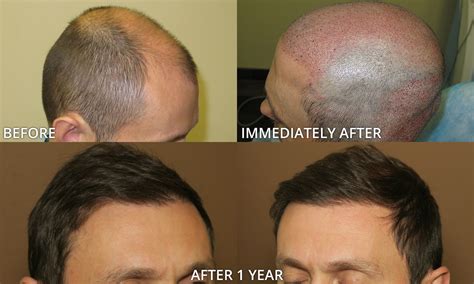 3500 Grafts Hair Transplant Before And After - Before And After Graft Strip Surgery, 47 Year Old ...