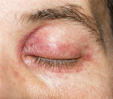 Eyelid Dermatitis Eczema Symptoms Causes And Treatment | Images and ...