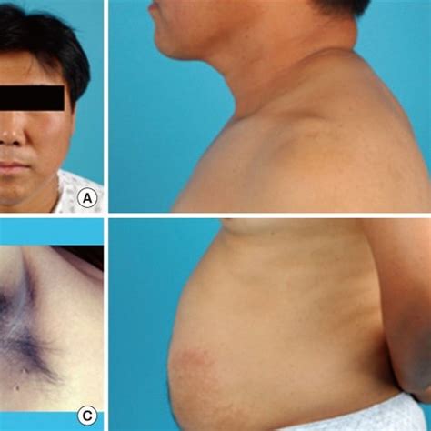 General appearance of the patient. (A) In the face, features suggesting ...