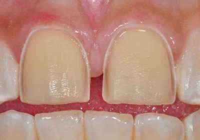 Should Your Cosmetic Dentist Use a Crown or Veneer After Root Canal ...