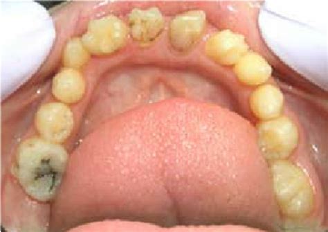 The abnormal shape of the mandibular teeth presenting dens-in-dente can... | Download Scientific ...