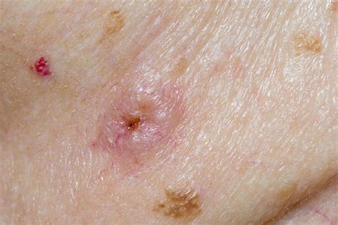 Squamous Cell Carcinoma | Skin Cancer Clinic