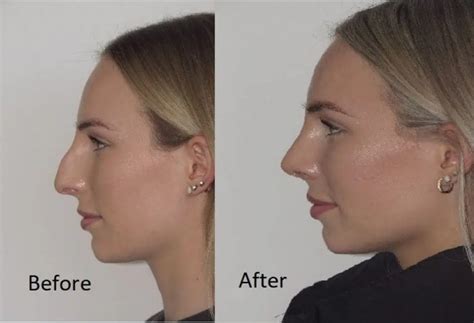 Nasal Dorsum Surgery – Rhinoplasty to Correct the Nose Bridge - Dr Jeremy Hunt