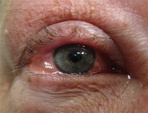 Allergic Conjunctivitis - PREP Duke Elder