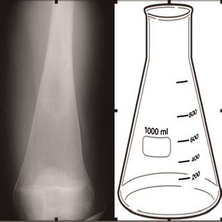 (PDF) Quantifying the Erlenmeyer flask deformity