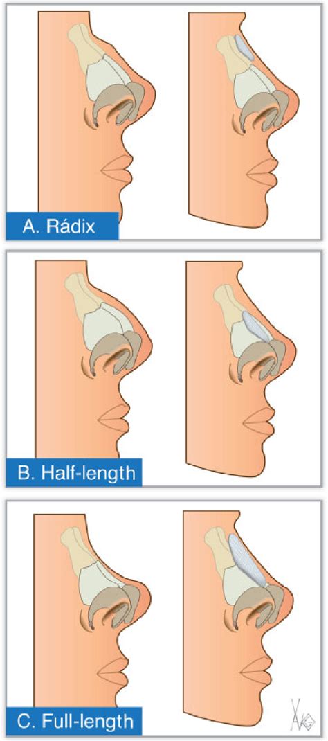 Different anatomical standards of the nasal dorsum with Mestizo... | Download Scientific Diagram