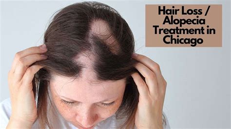 Hair Loss / Alopecia - Kovak Cosmetic Center Chicago Illinois