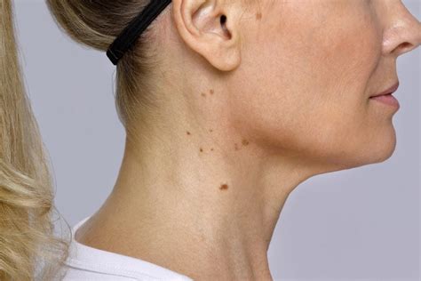 If You Have Bumps on Your Neck, Here's What It Could Mean | Reader's Digest