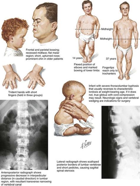 Pediatric Orthopaedics | Musculoskeletal Key